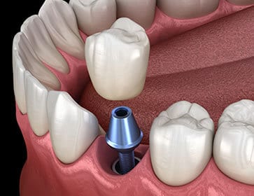 tooth implant - dentist Hannibal MO - Hannibal Dental Group - dentist near me - emergency dentist - dental clinic near me - Endodontics - dental implants near me - Invisalign near me - Teeth Whitening - Teeth Whitening