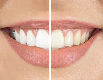 Teeth Whitening - Teeth Whitening Dentist - dentist Hannibal MO - Hannibal Dental Group - dentist near me